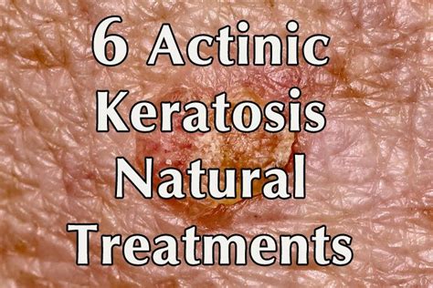 Tested Actinic Keratosis Natural Treatments Health Natural Treatments Natural Mole