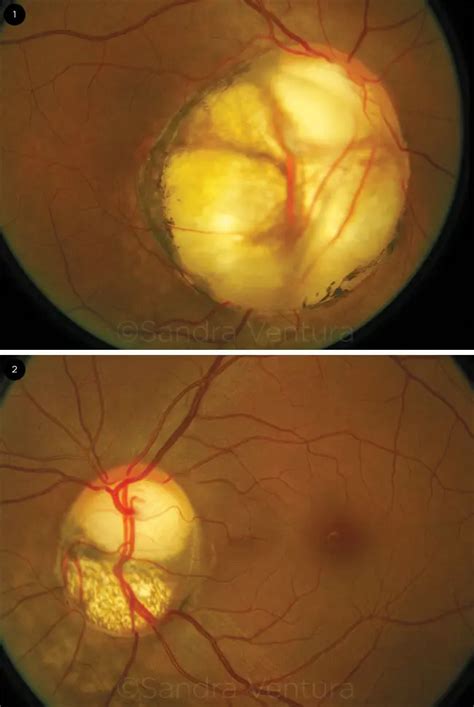 Colobomas Of The Optic Nerve American Academy Of Ophthalmology