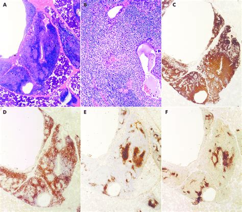 Typical Immunoarchitecture Of Mucosa Associated Lymphoid Tissue Malt