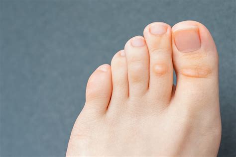 What Are Corns And Calluses Prevention And Treatment Feet First Clinic