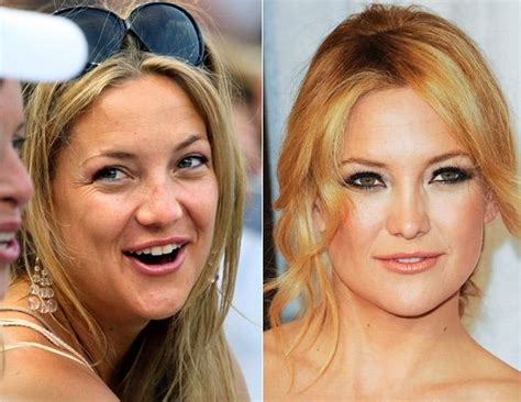 Kate Hudson Nose Job And She Has Also Had A Breast Augmentation This