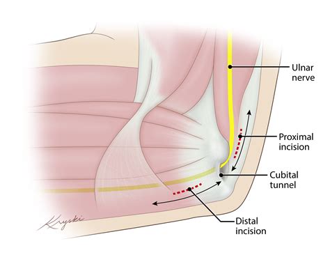 Cureus Case Series A Minimally Invasive Tunneling Approach For