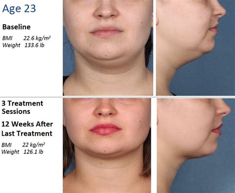 Kybella Before And After Cheeks