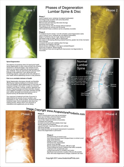 Lumbar Vertebral Spinal Degeneration Poster 18 X 24 Chiropractic Chart