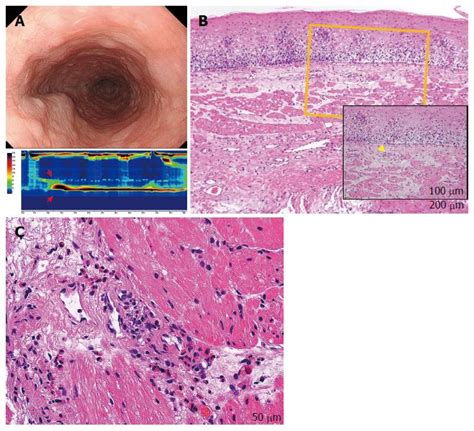 Proposed Criteria To Differentiate Heterogeneous Eosinophilic