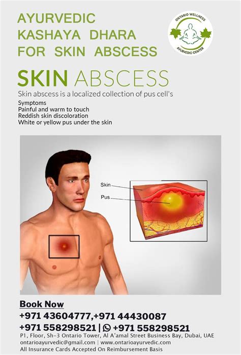 Ontario Ayurvedic Wellness Center Skin Abscess Ayurvedic Kashaya