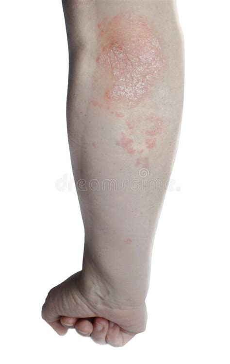 Acute Psoriasis On Elbows Is An Autoimmune Incurable Dermatological