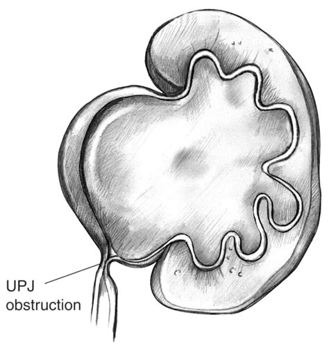 Swollen Kidney That Results From Ureteropelvic Junction Obstruction
