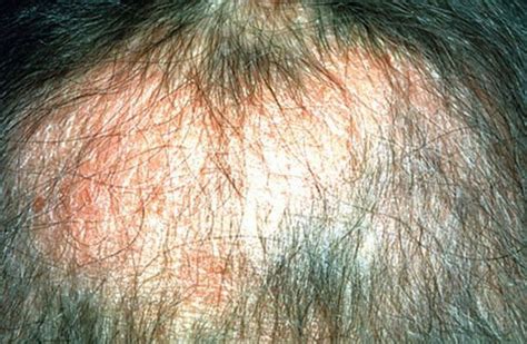 Inflammatory Diseases Of Hair Follicles Sweat Glands And Cartilage
