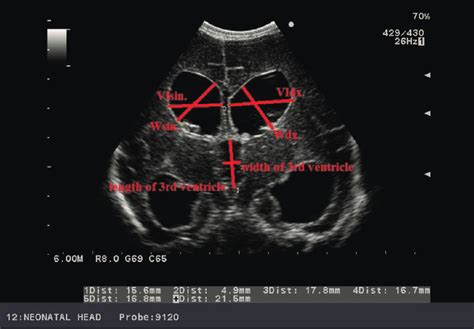 Examination Of The Brain Of A Neonate By Transcranial Download