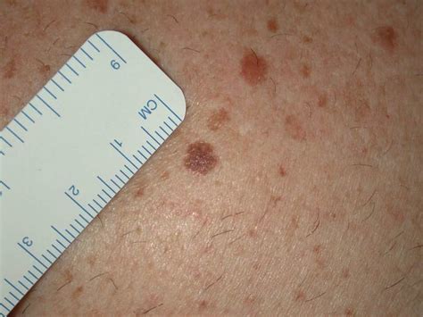 Spot The Difference Harmless Mole Or Potential Skin Cancer