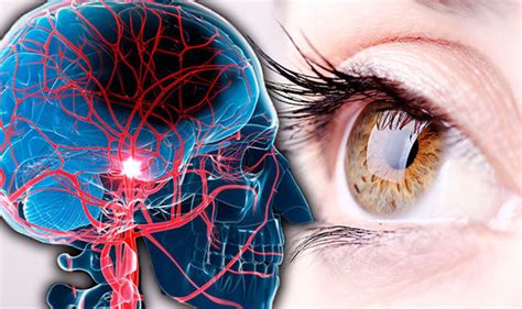 Stroke Symptoms Signs Include Reduced Vision Field Eye Risk Revealed
