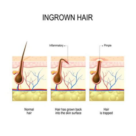 Ingrown Hair On Scalp Symptoms Treatment Cure