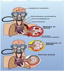 The Risks Of Scuba Diving Pulmonary Embolism DesertDivers