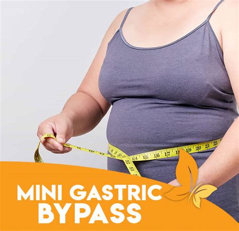 Mini Gastric Bypass Bariest