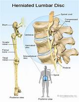 Chiropractic Treatment For Herniated Disc