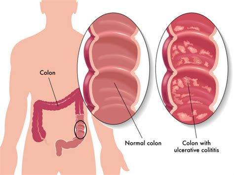 Ulcerative Colitis Foods To Avoid During Flare Ups University Health