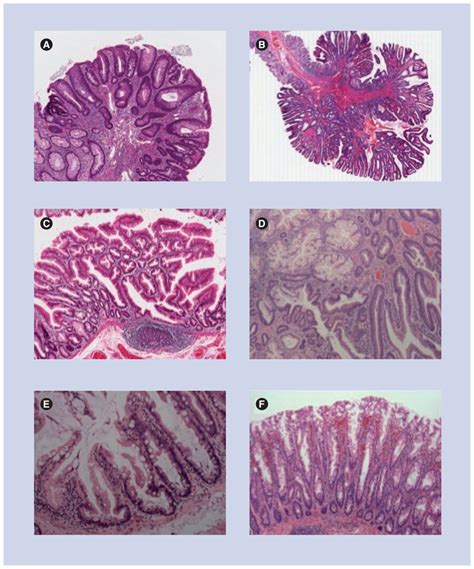 Tubular Adenoma Histology