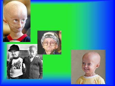 Progeria By Monica Cruz Mutation In The Gene