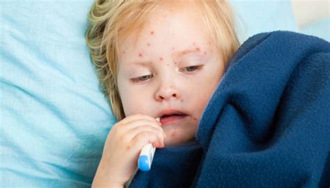 Scarlet Fever Symptoms Diagnosis And Treatment Tips For Womens