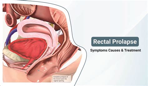 Rectal Prolapse Symptoms Causes Diagnosing Treatment