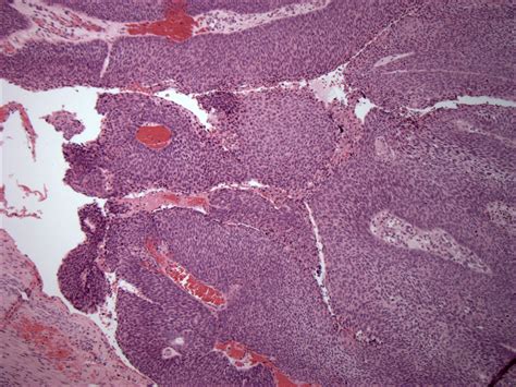 Pathology Outlines Nasopharyngeal Carcinoma