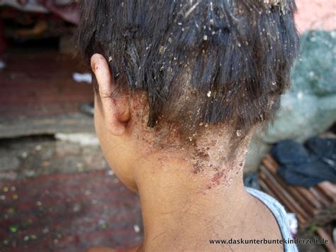 These tiny, and sometimes microscopicly tiny black bugs are carpet bettles! Extreme case of #lice #headlice... #poverty http ...