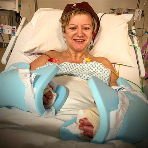 Scots Mum Who Had Parts Of All Four Limbs Amputated To Save Life After Pneumonia And Sepsis