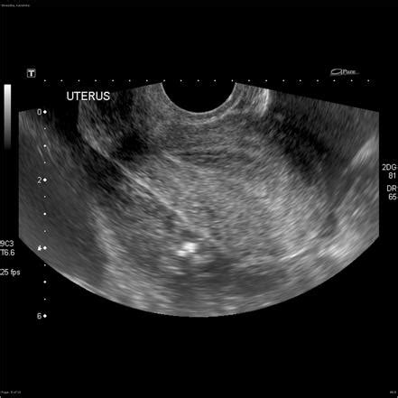 Ruptured Ectopic Pregnancy Radiology Case Radiopaedia Org