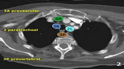 Radiological Anatomy Of Thoracic Lymph Nodes Ppt