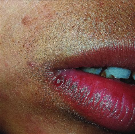 B Near Complete Resolution Of A Pyogenic Granuloma On The Lip With