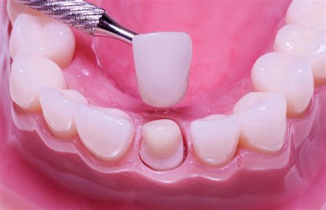 Dental Crowns Types Cost Private And Nhs Before And After