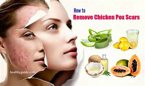 20 Tips How To Remove Chicken Pox Scars On Face Skin Naturally After A Week