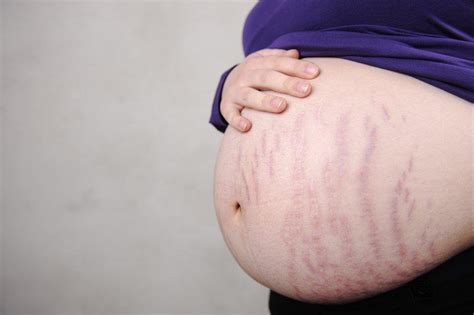 Stretch Marks During Pregnancy Why Do Some People Get It Some Dont Vinmec