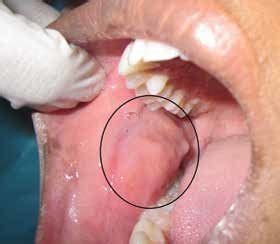 Oral Cancer Buccal Mucosa