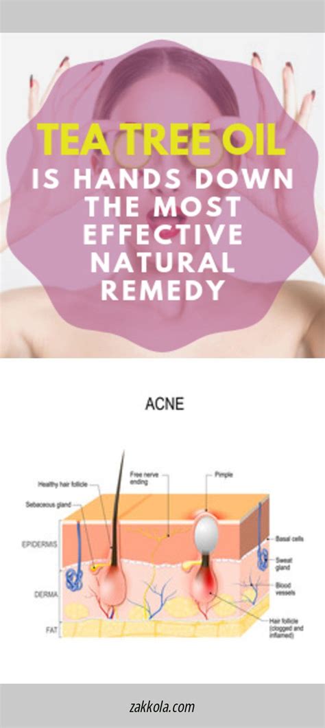 How To Treat Scalp Acne Scalp Pimple Are Itchy And Annoying Here Are