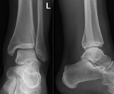 Mortise And Lateral View X Ray Of Left Ankle Mortise And