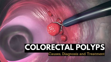 Colorectal Polyps Causes Signs And Symptoms Diagnosis And Treatment