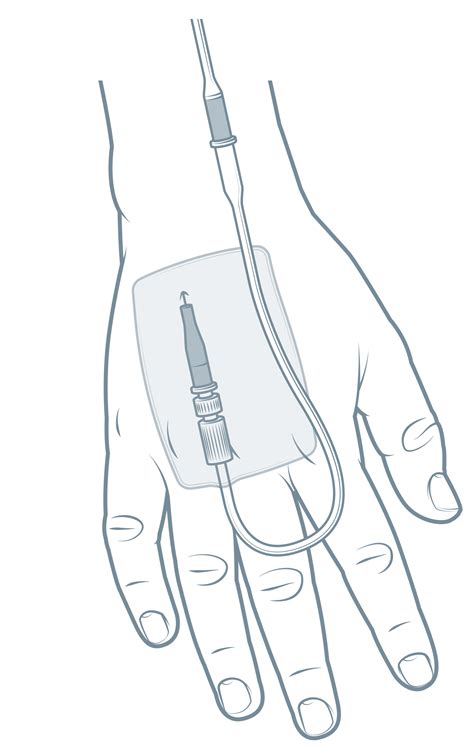 Clinical Guidelines Nursing Peripheral Intravenous Iv Device