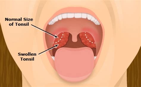 Contact the branch manager, the customer service hotline, or the institution's website. Tonsillectomy adenoidectomy by Mitchell Austin MD FACS in ...