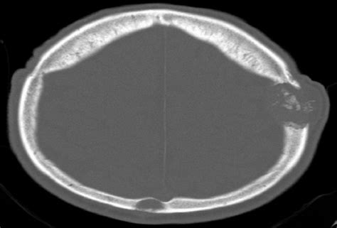 Cerebral Ct Scan Bone Window Osteolytic Lesion In The Left Frontal