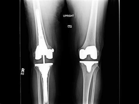 Complications After Total Knee Arthroplasty Clinical Pain Advisor