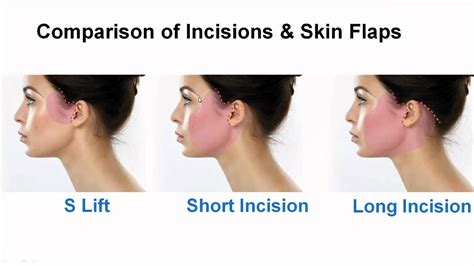 Part 813 Comparison Of Face And Neck Surgery Incisions Dr Buonassisi