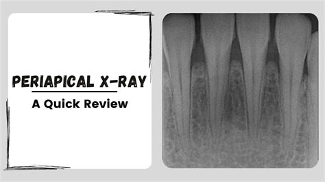 Periapical X Ray Intraoral Dental Radiograph Youtube