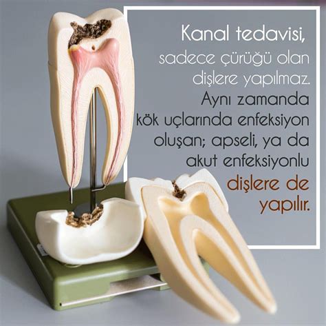 KANAL TEDAVİSİ Kanal tedavisi diğer bir adıyla endodontik tedavi ...