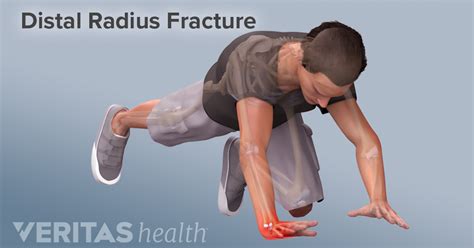 Symptoms Of A Distal Radius Fracture