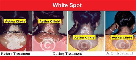 How To Cure Vitiligo Best Treatment Of Vitiligo In Rajasthan Ajmer
