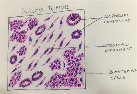 Wilms Tumor Histopathologyguru