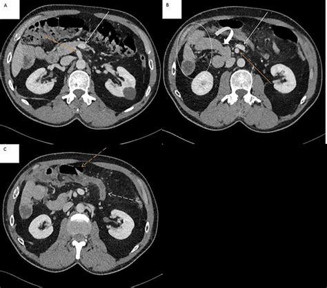Multiple Sections Of Axial Contrast Enhanced Ct Abdomen Axial