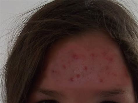 Mitesser entfernen ohrdr, pimple, popper, drpimplepopper, drsandralee, sandra lee, extraction, blackhead, whitehead, milia, cyst, skin, skin care, beauty, fa. nealkhoerr: Pickel Im Gesicht Chinesische Medizin